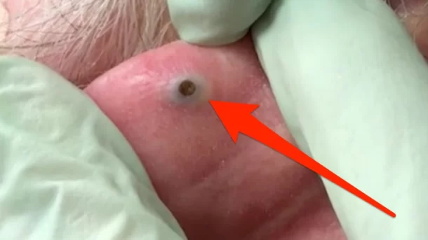 Dr. Pimple Popper posts behind-the-ear blackhead video on social media