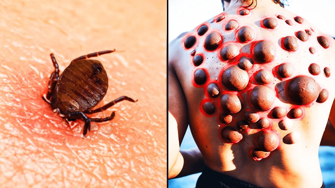 Boy Thought It Was Just a Bedbug Bite – What He Woke Up to Will Shock You!