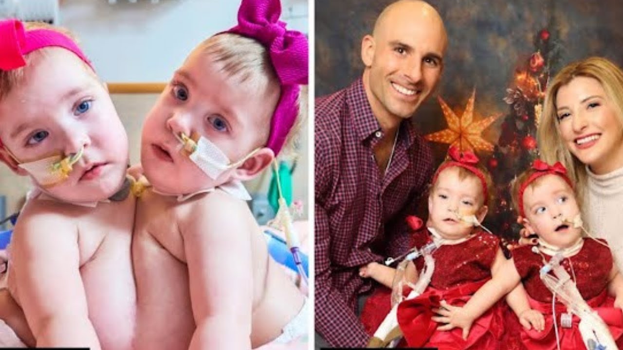 Miracle Twins Born Conjoined: See How They Look Today!